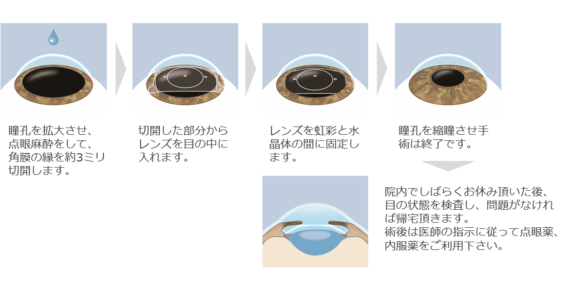 ICLの流れ