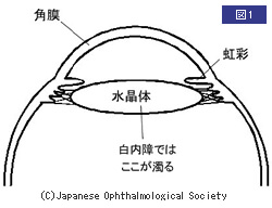 白内障