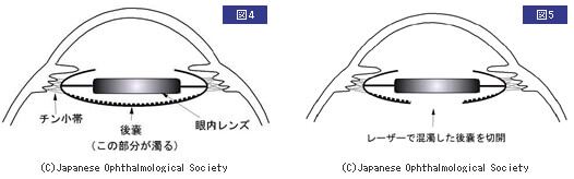 手術後の合併症