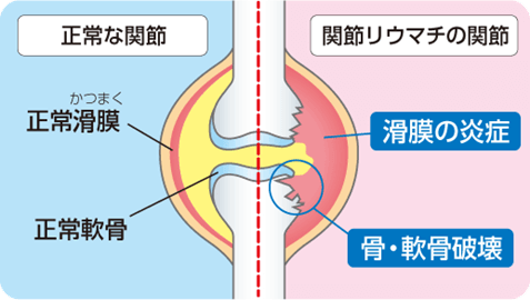 関節リウマチの関節の変化