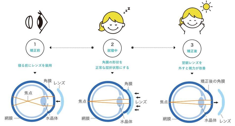 治療の仕組み