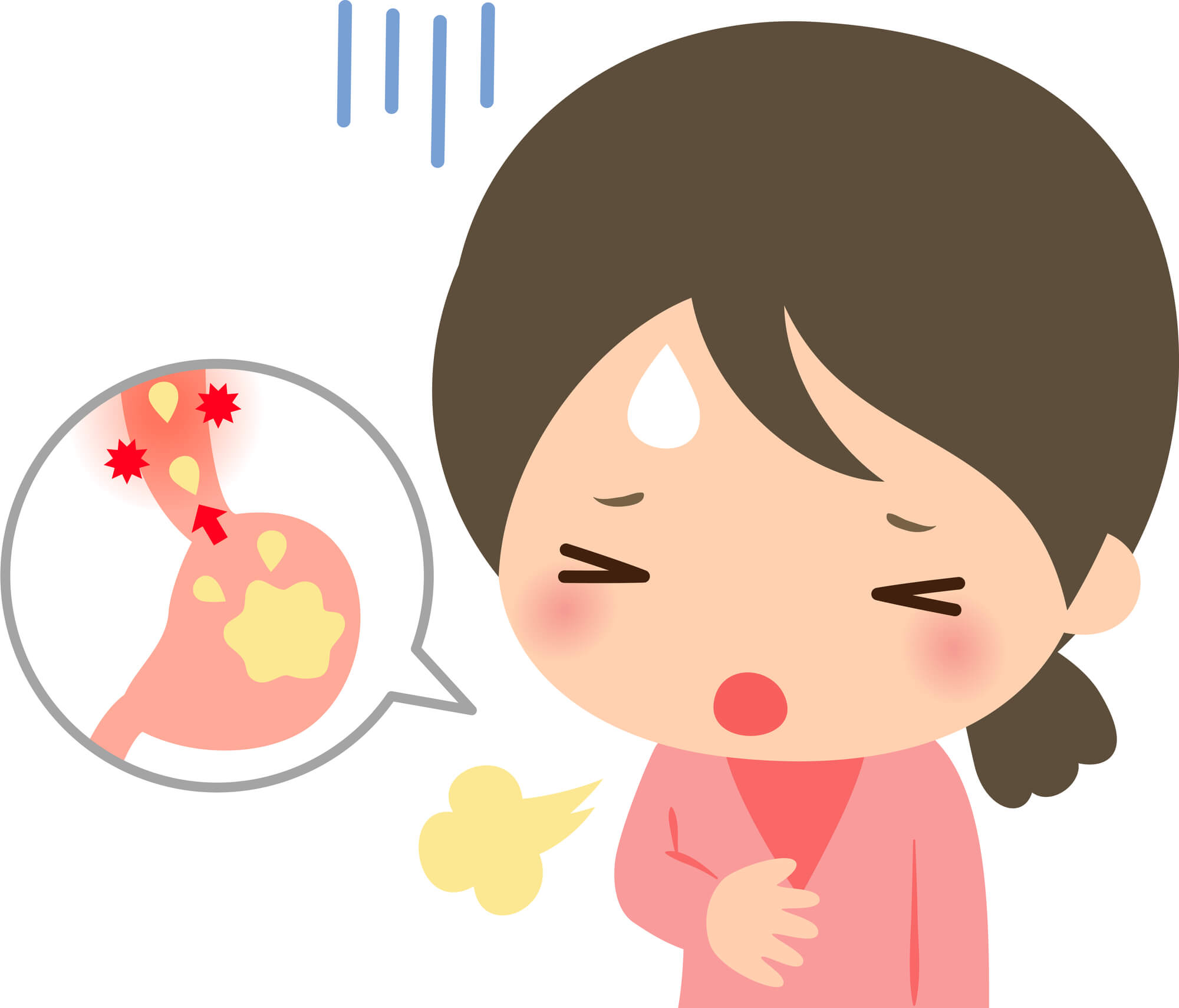 逆流性食道炎イラスト