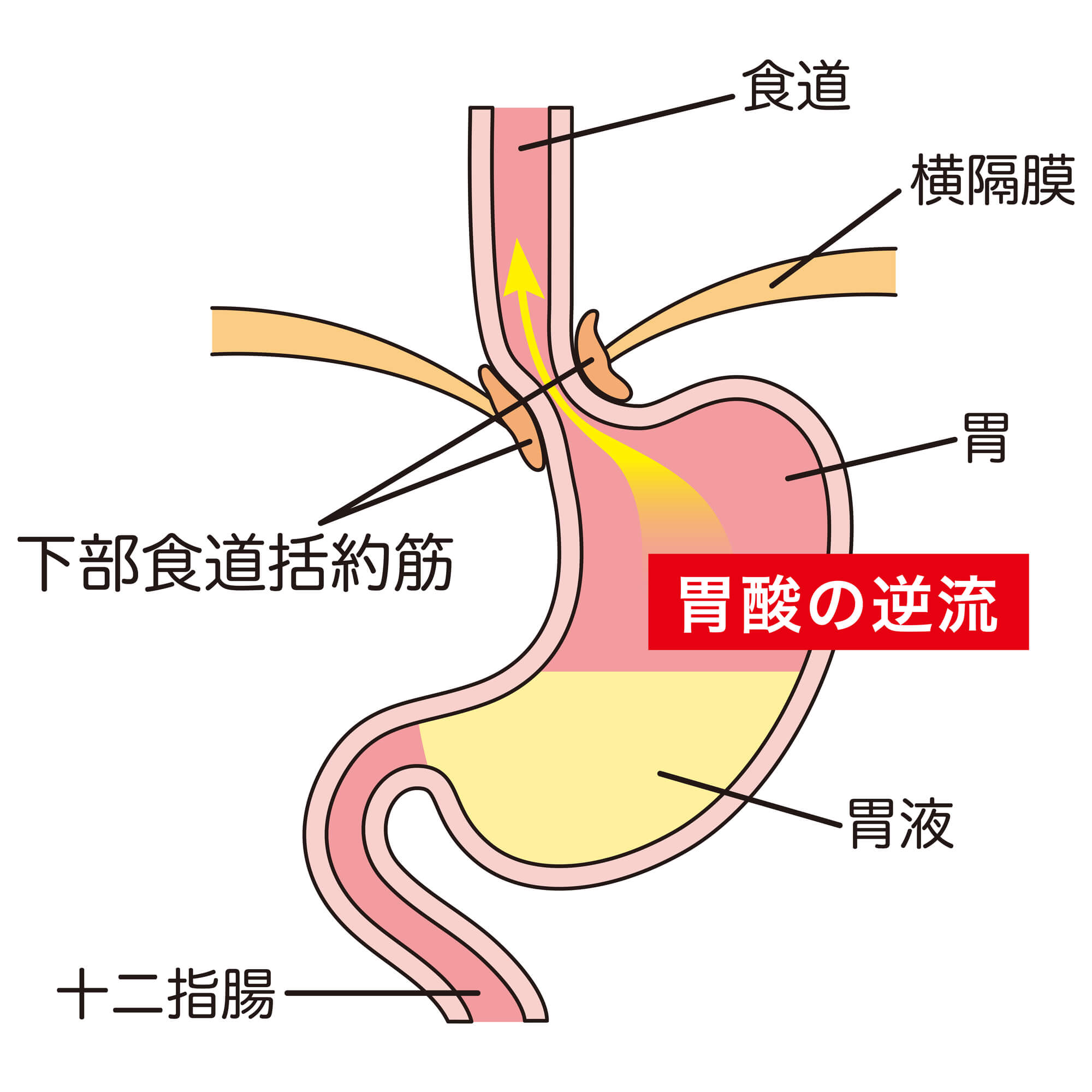 逆流性食道炎の仮説図